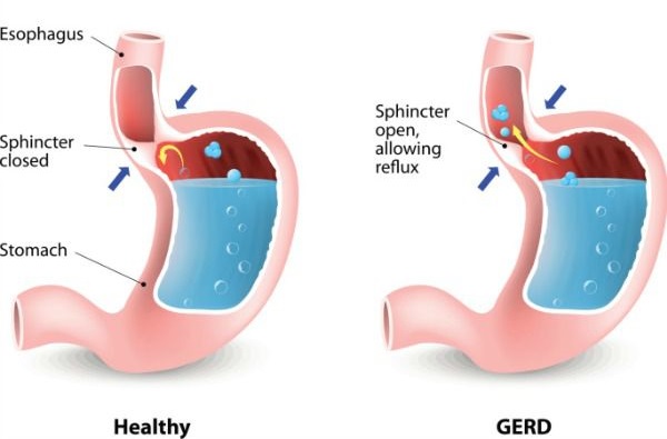 Significance of Lifestyle Intervention for Patients of Gastroesophageal ...